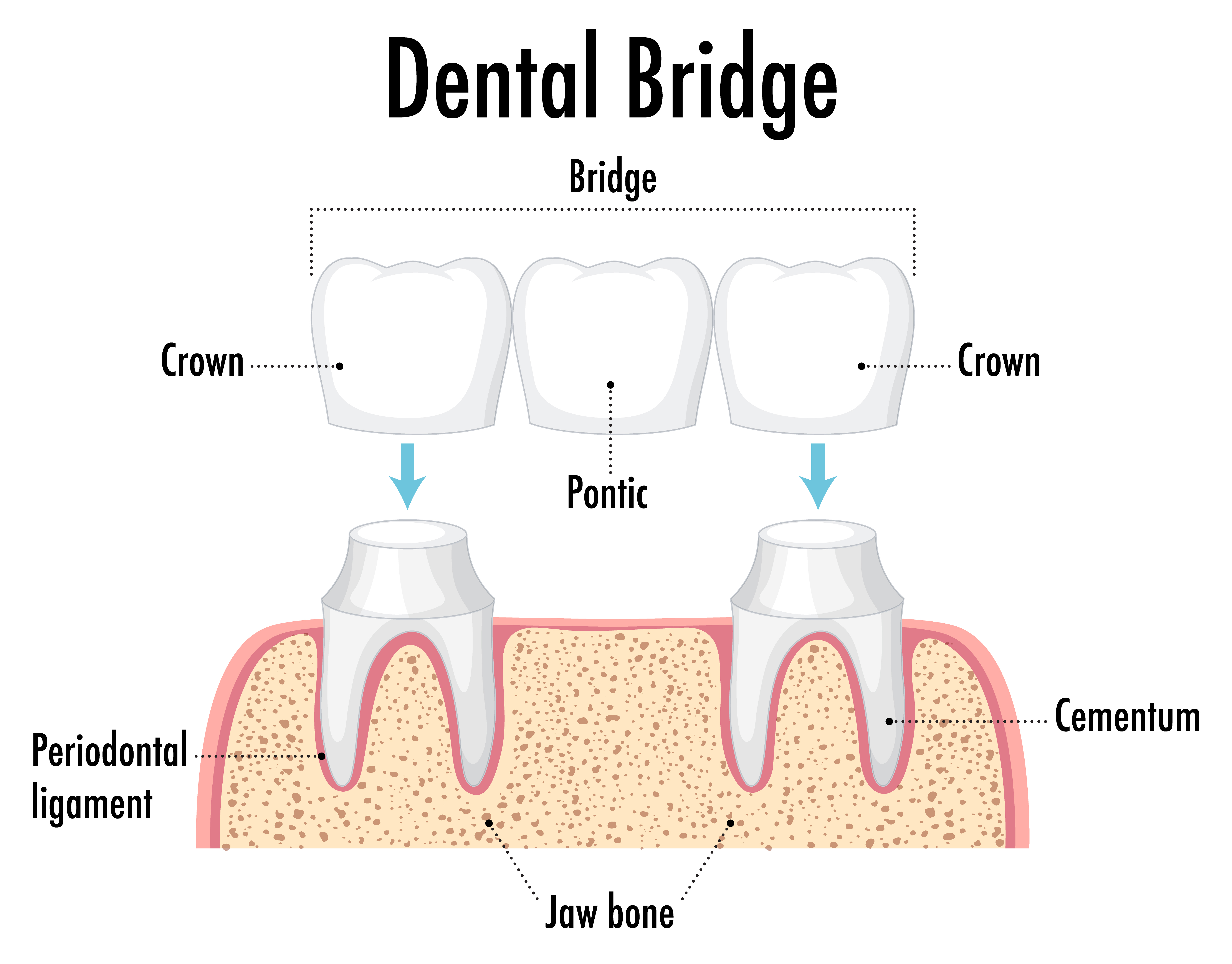 diagram of dental bridge sleep dentistry dr. mahoney