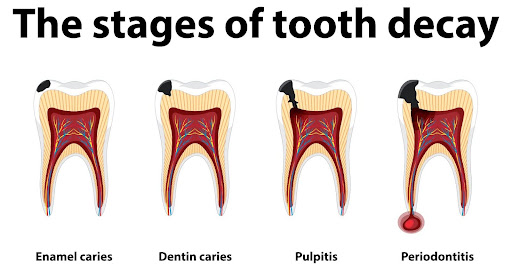 diagram of the stages of tooth decay enamel caries dentin carries pulpitis periodontitis sleep dentistry erie how to protect teeth from acid reflux  